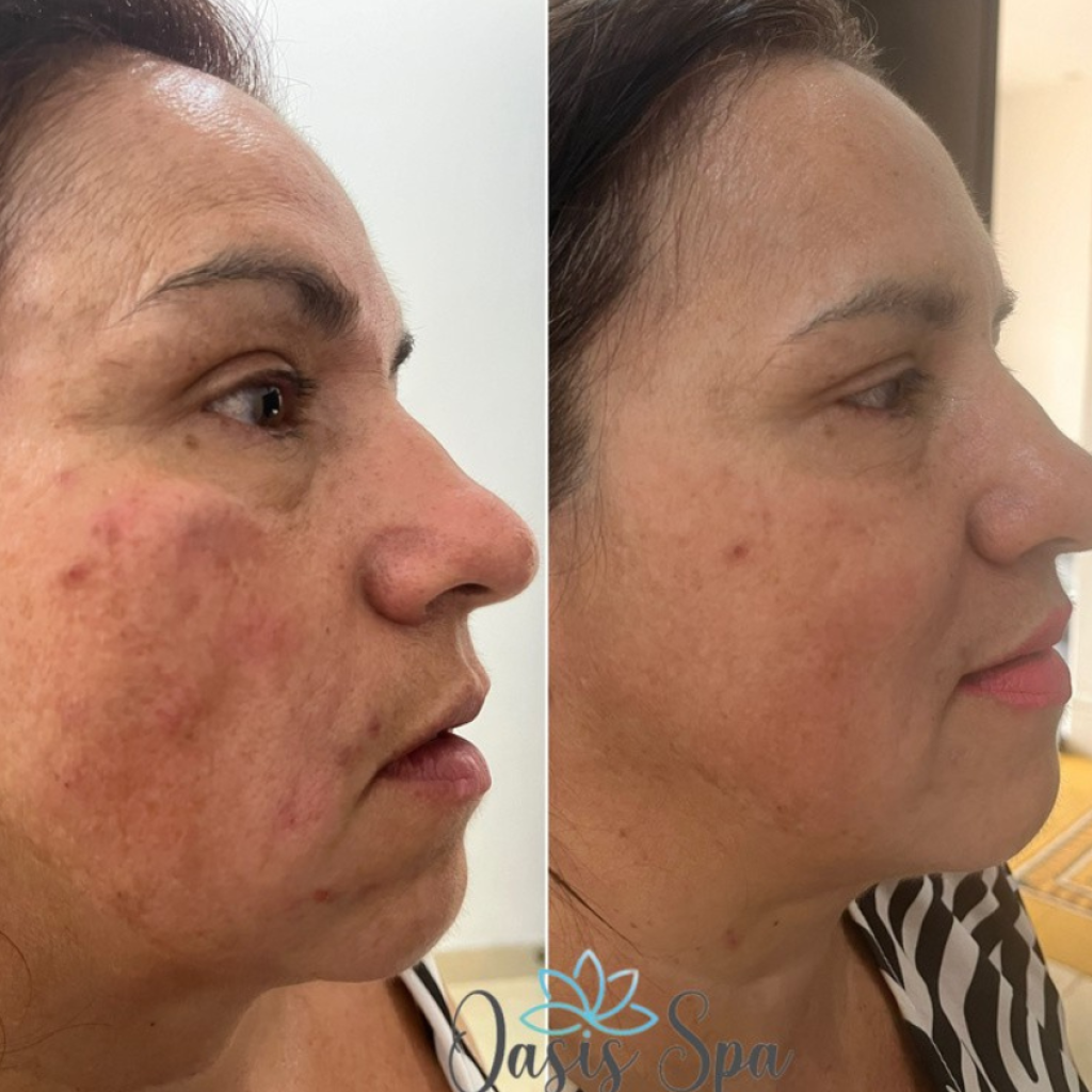 faciales (4)